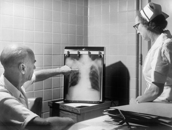 Lung X-ray Medical staff examine a lung X-ray.